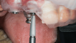 Conservación, periodoncia, cirugía e implantes del Ciclo FP Superior en Higienista Bucodental